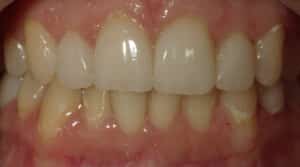 After Image: Veneers