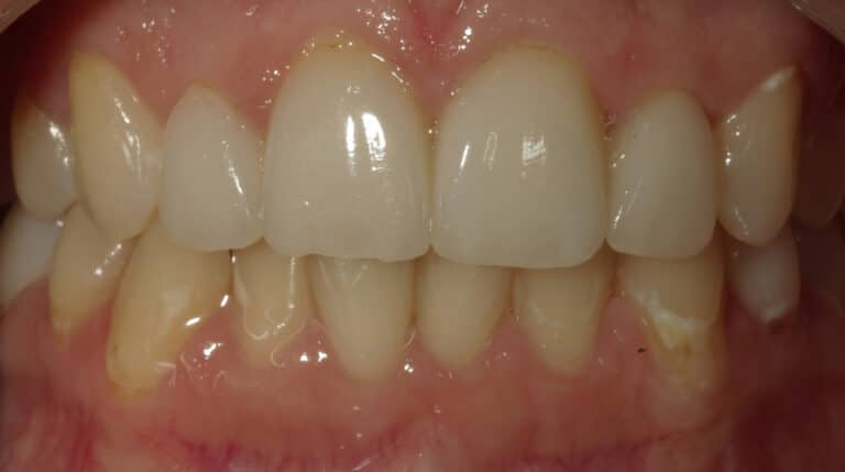 After Image: Veneers - front