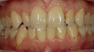 Before Image: Veneers