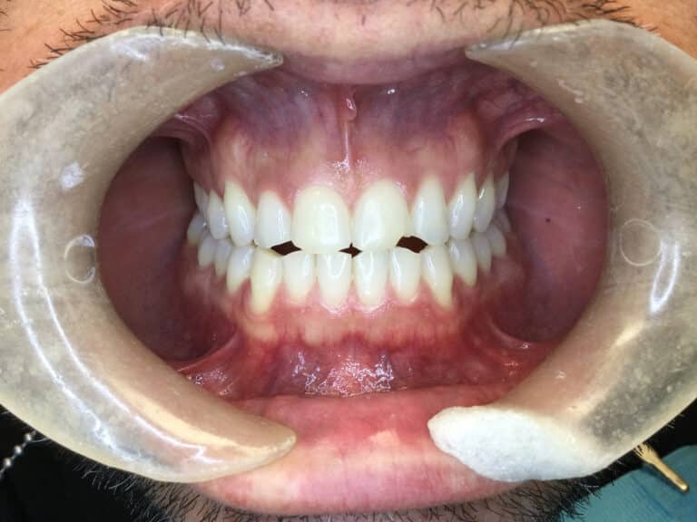 Before Image: No Cutting Bonding - front