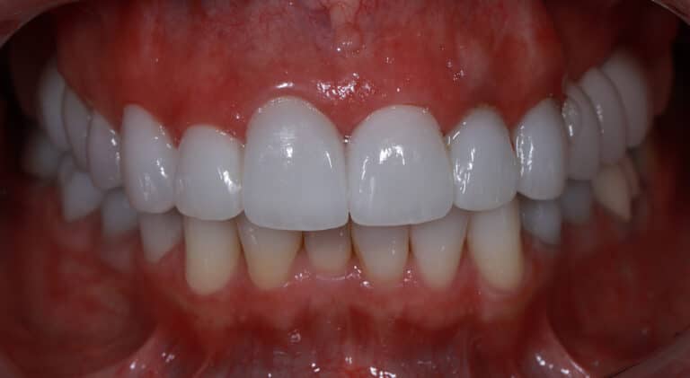 After Image: Veneers - front