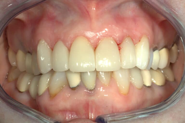 After Image: Veneers - front