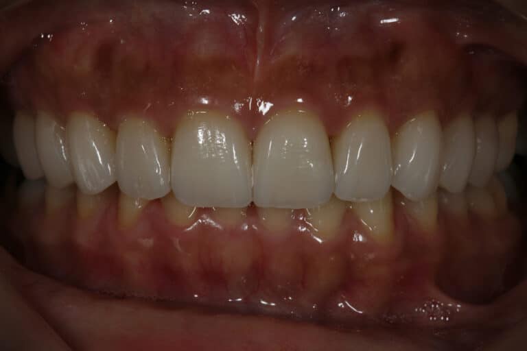After Image: Veneers - front