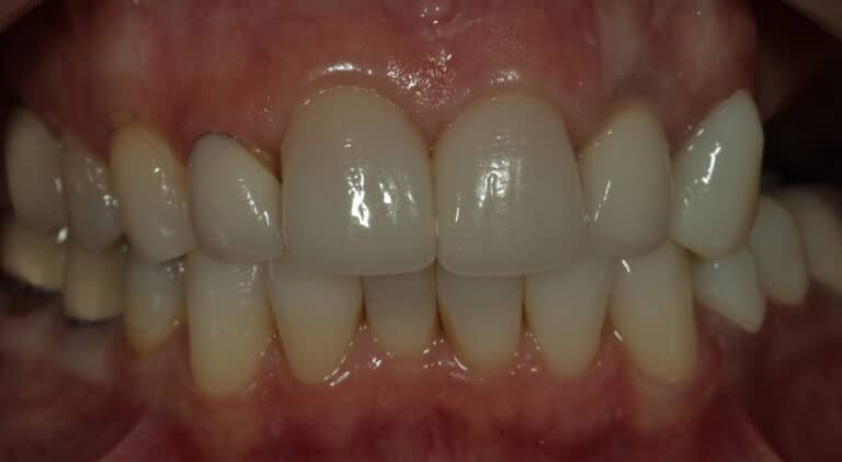 Before Image: Veneers - front