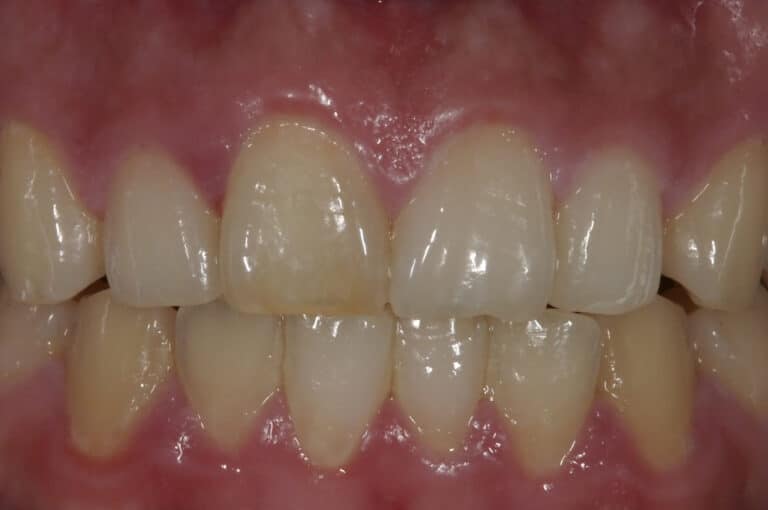 Before Image: Veneers - front