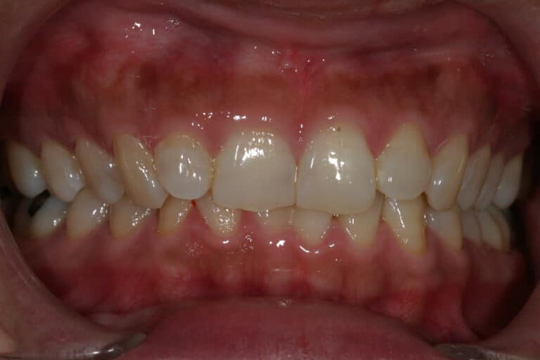 Before Image: Veneers - front