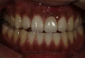 After Image: Veneers