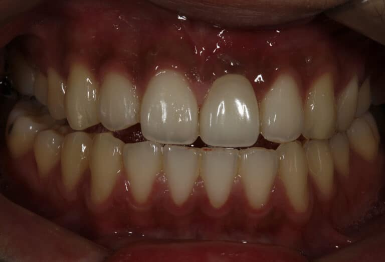 After Image: Veneers - front