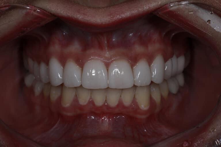 After Image: Veneers - front