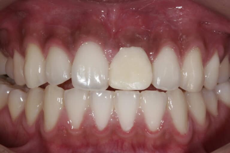 Before Image: Veneers - front