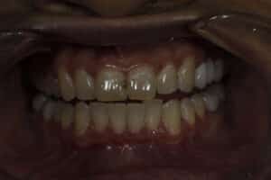 Before Image: Veneers
