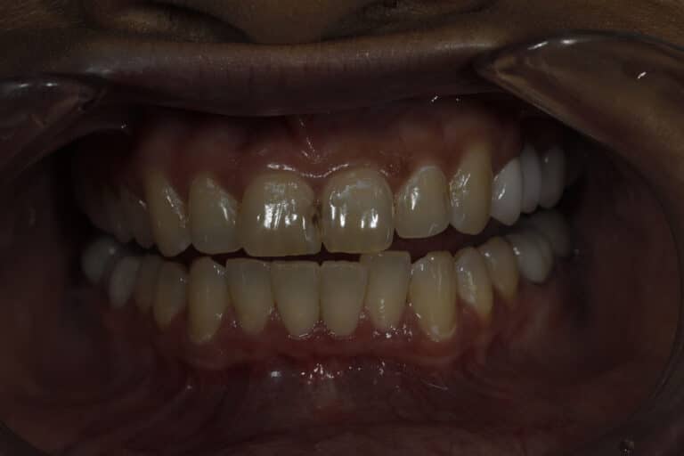 Before Image: Veneers - front